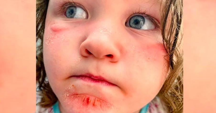 Mom Warns Others After Discovering Daughter's Bizarre 'Sunburn' Is Actually A Chemical Burn