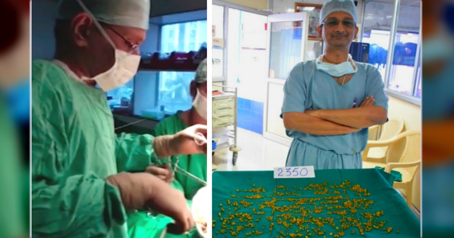 Woman Ignored Pain for 18 Months Until Doctors Removed 2,350 Gallstones