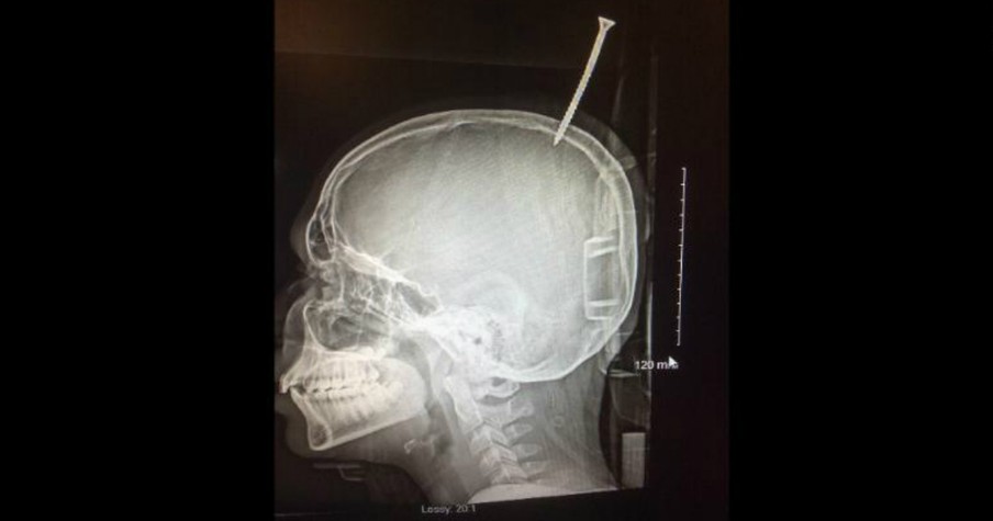 Freak Accident Leaves Boy With Screw In Skull 'A Millimeter Away' From Death