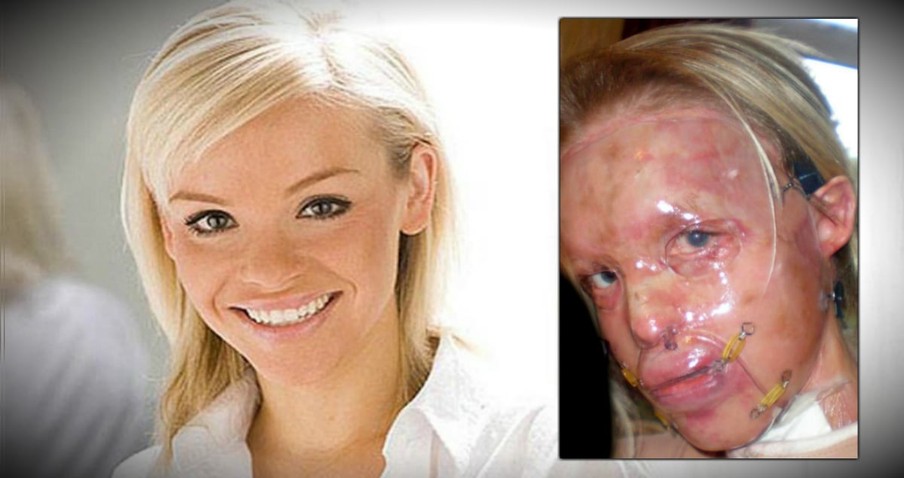 Acid Attack Survivor Katie Piper Is Moving On And Helping Others