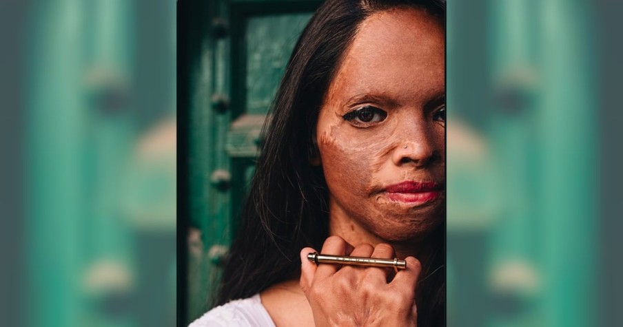 Inspirational True Story of Woman Finding Love After Acid Attack Nearly Killed Her