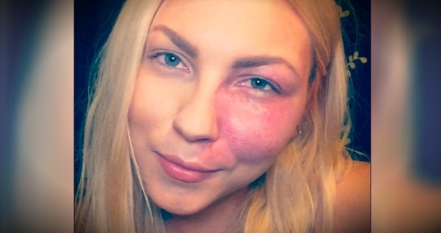 Bullied For Her Birthmark, This Actress Says To "Love Your Flaws"