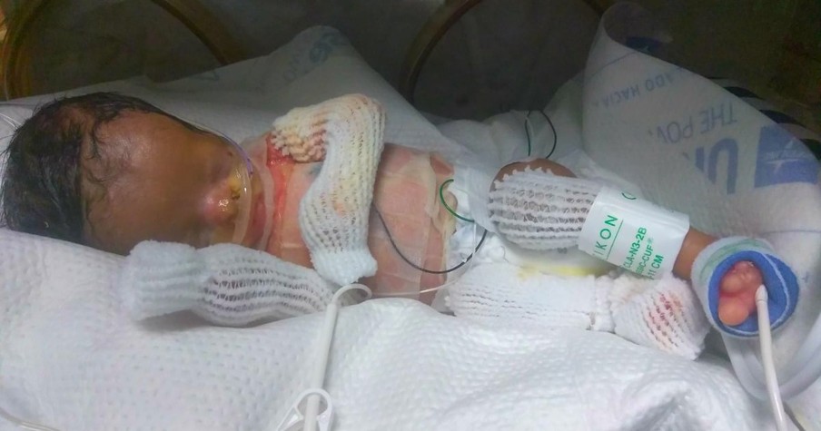 Baby Born With No Skin Baffles Doctors And His Family Needs Prayer