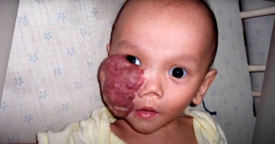 Parents Make Heartbreaking Decision to Give up Baby with Facial Tumor, Then Reunite Years Later