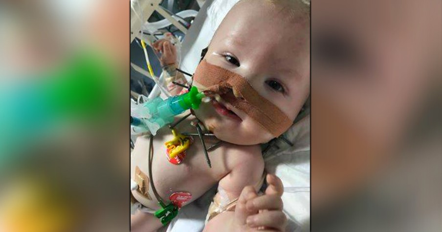 Baby Boy Is A Living Miracle As First To Undergo Bizarre Facial Operation