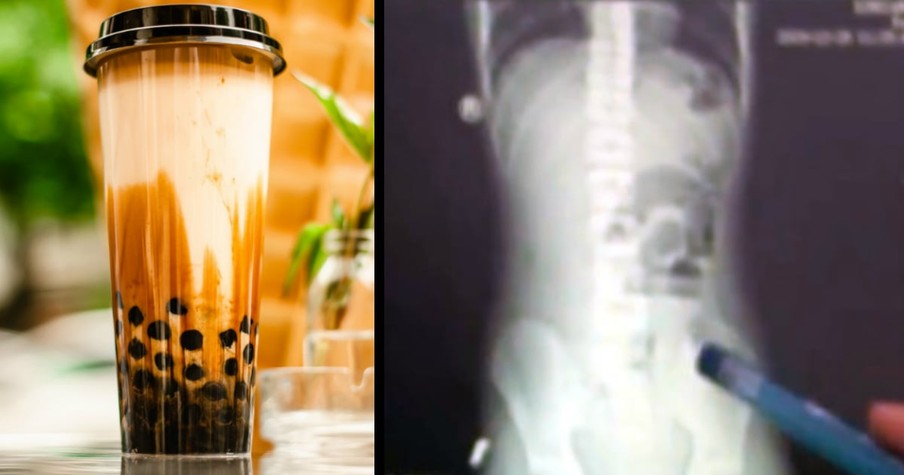 Teen Rushed to Hospital With Bizarre Condition And Doctors Blame Bubble Tea