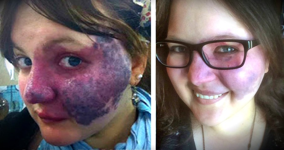 Brave Woman Uses The Birthmark Bullies Targeted To Inspire Others