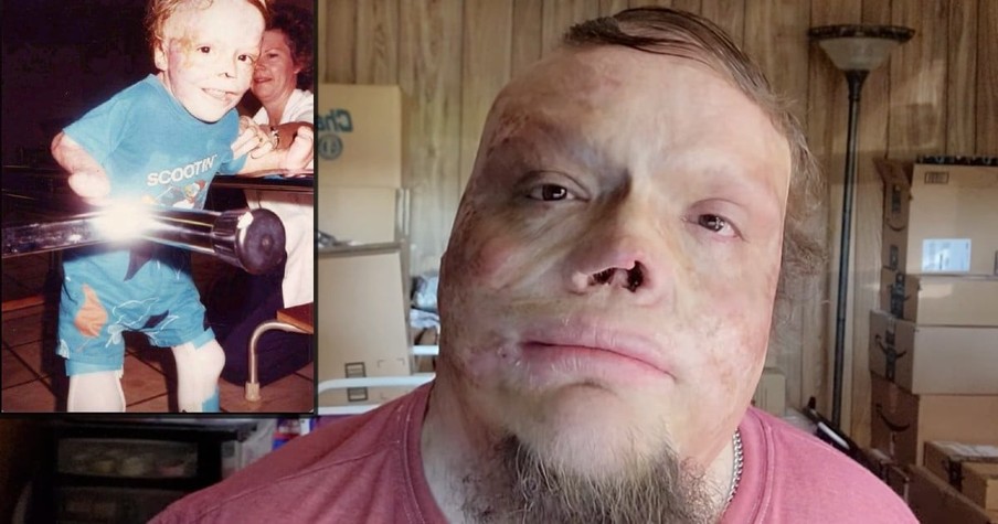 He Wasn't Supposed To Survive But This Burn Victim Dad Inspired So Many With His Story