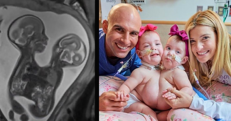 Frightened Parents 'Give It To God' As Conjoined Twins Are Separated In 10-Hour Surgery