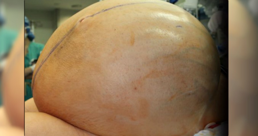 Doctors Race To Remove Enormous 132-Pound Tumor From Desperate Woman