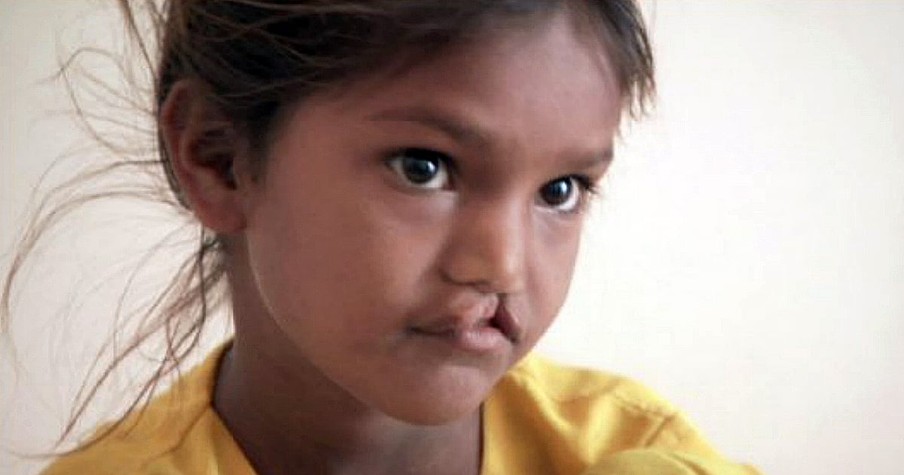 Free Cleft Lip Surgery For A Girl Named Pinki Thanks To Stranger's Act Of Kindness