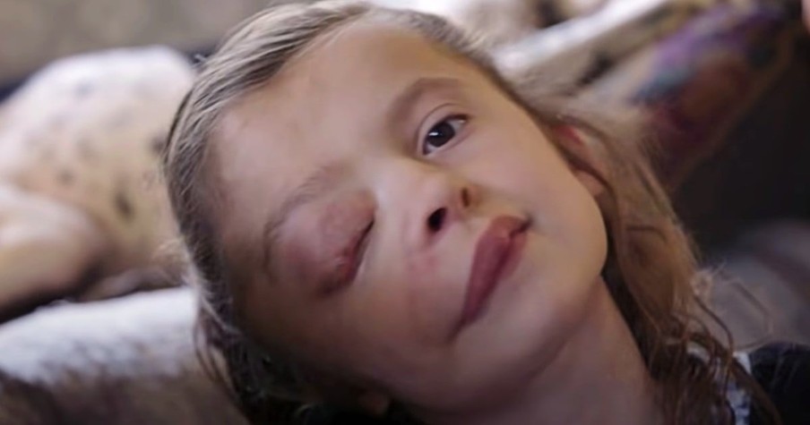 Sweet 10-Year-Old Girl with Rare Facial Tumor Ignores Those Who Laugh And Inspires Us All