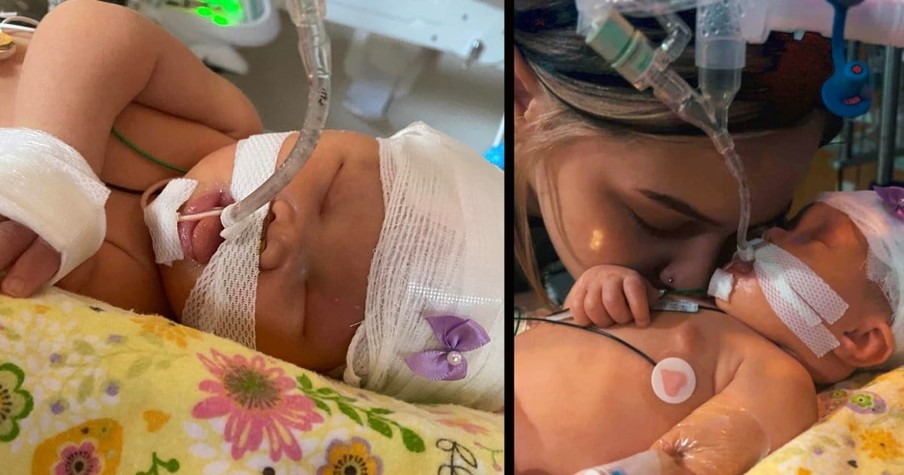 Baby Born without Eyes and Had Half Her Brain Removed Shocks Doctors by Thriving