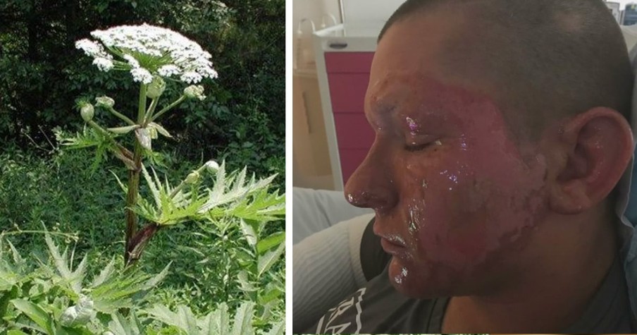 Dangerous Plant Worse Than Poison Ivy Sent A Teen To The Hospital