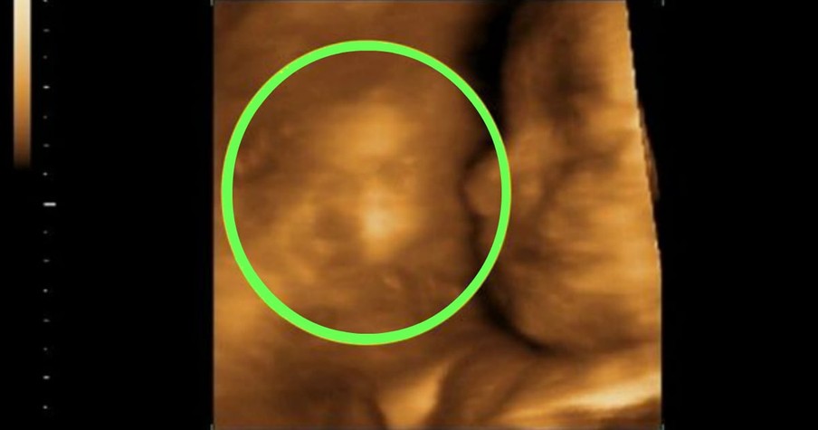 Mom Goes Ultrasound Of Rainbow Baby And Sees A Second Face