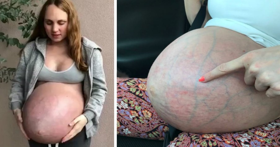 Internet Responds When Woman Expecting Triplets Shows Her 'Strange' Bump Online