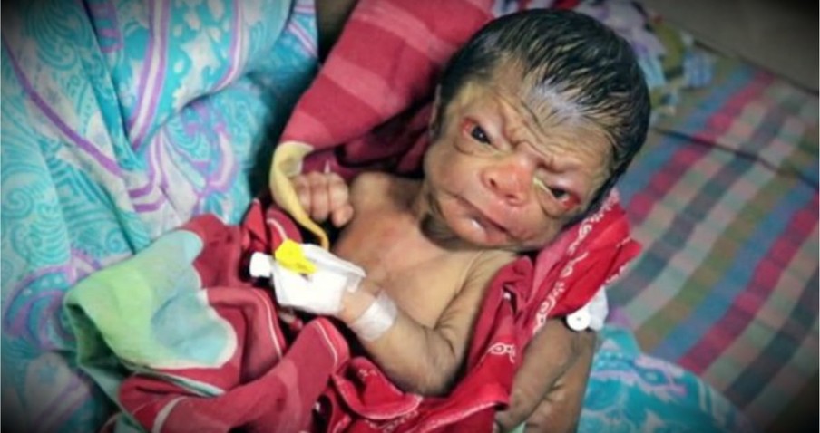 A Rare Disease Makes This Newborn Resemble An Old Man