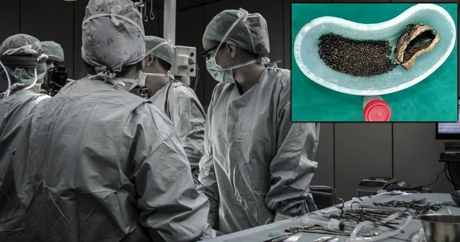 Man Ignored Pain for Years But Then Has Over 4,000 Gallstones Removed In Surgery