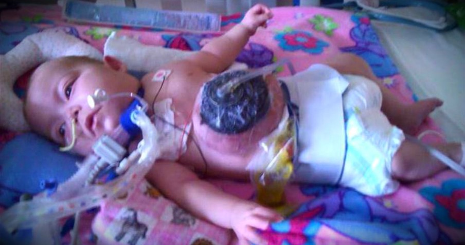 Baby With A Rare Birth Defect Gets Abandoned By Her Family And So Her Nurse Adopted Her