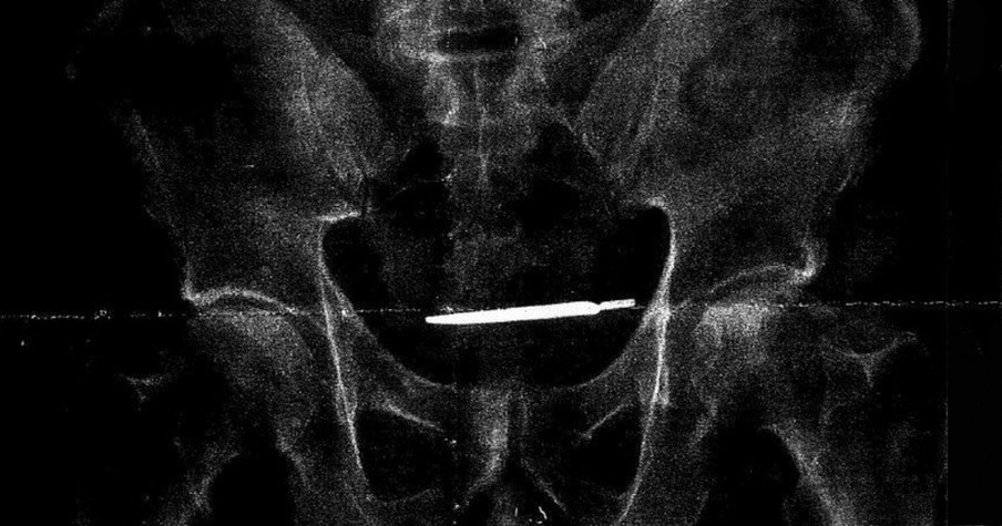 4 Years After Surgery, Army Veteran's X-Ray Reveals Doctors Left A Surgical Tool Behind