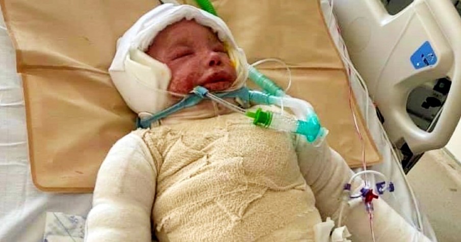 Mom Can't Even Touch 5-Year-Old Son Because Of Horrifying Condition Making His Skin Fall Off