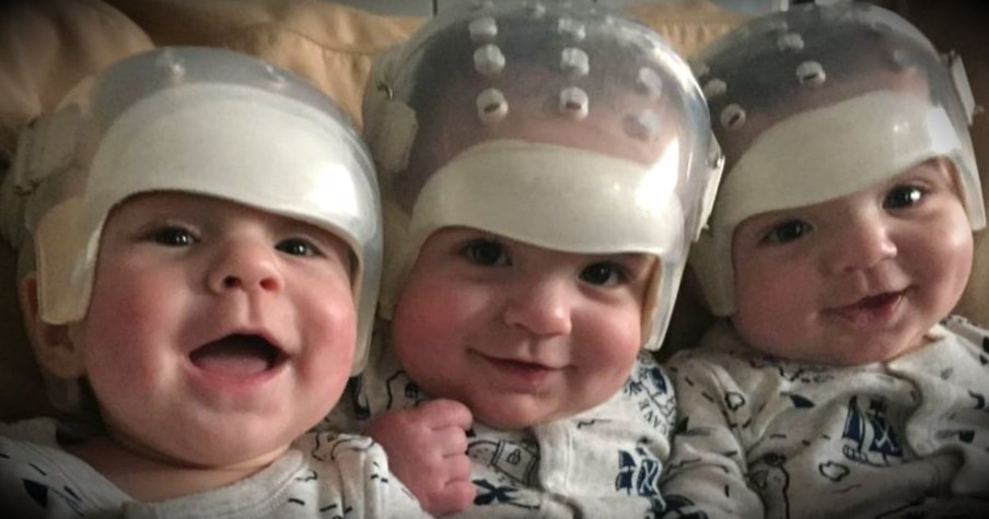 All 3 Triplets Share The Same Rare Birth Defect And Make Medical History