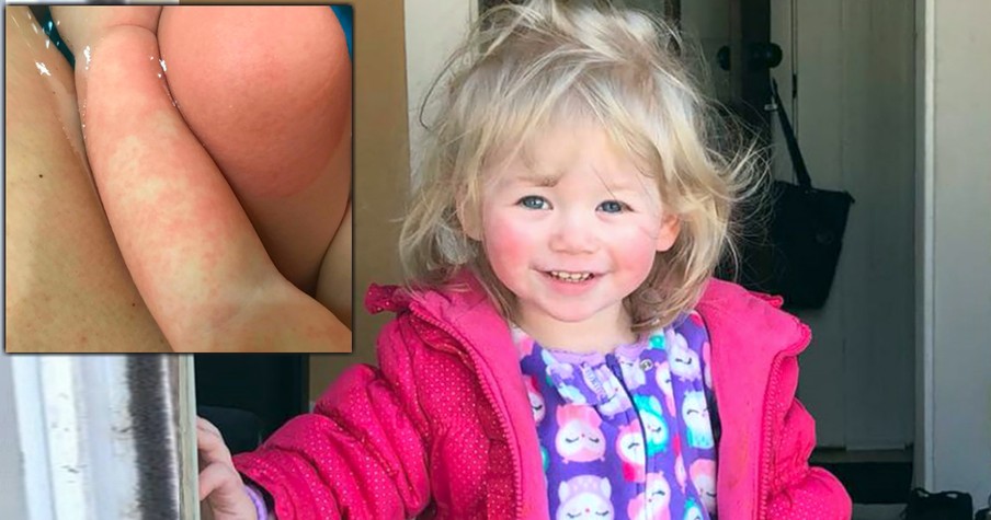 Toddler's Rash Is Result Of Rare Allergy That's Still Stumping Scientists