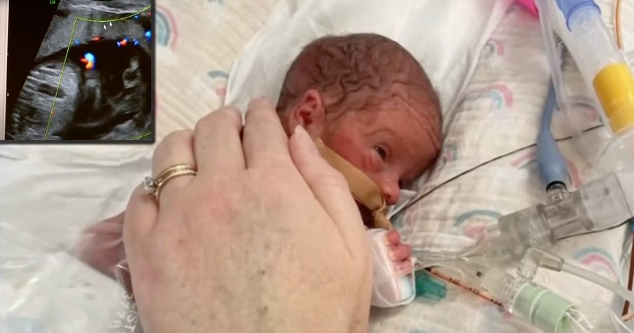 Doctors Rush To Save Baby Born With Tumor On The Spine That's Twice Her Size