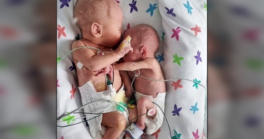 Baby Girl Defies Expectations And Survives To Cuddle Her Twin Brother In Sweet Photo