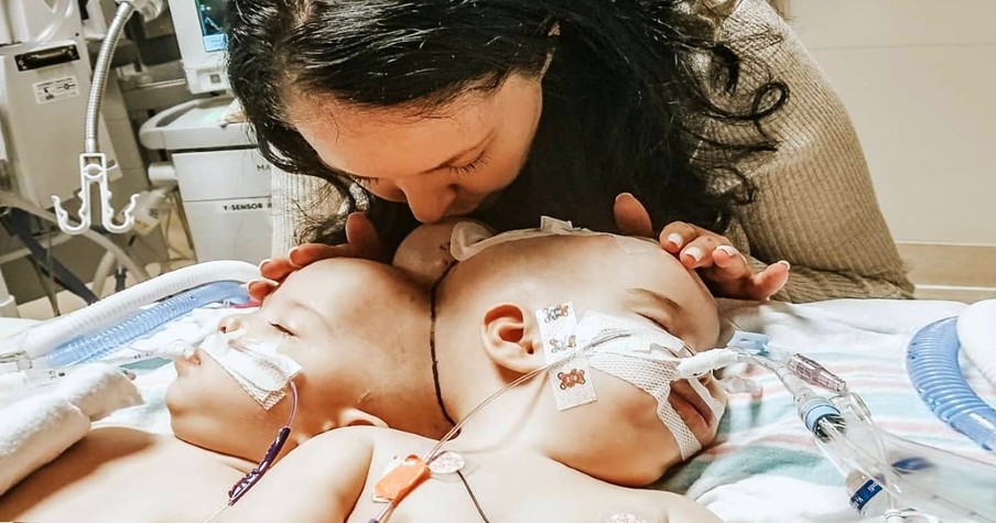 Parents of 9-Month-Old Twins Conjoined at the Head Praise God After They Are Separated