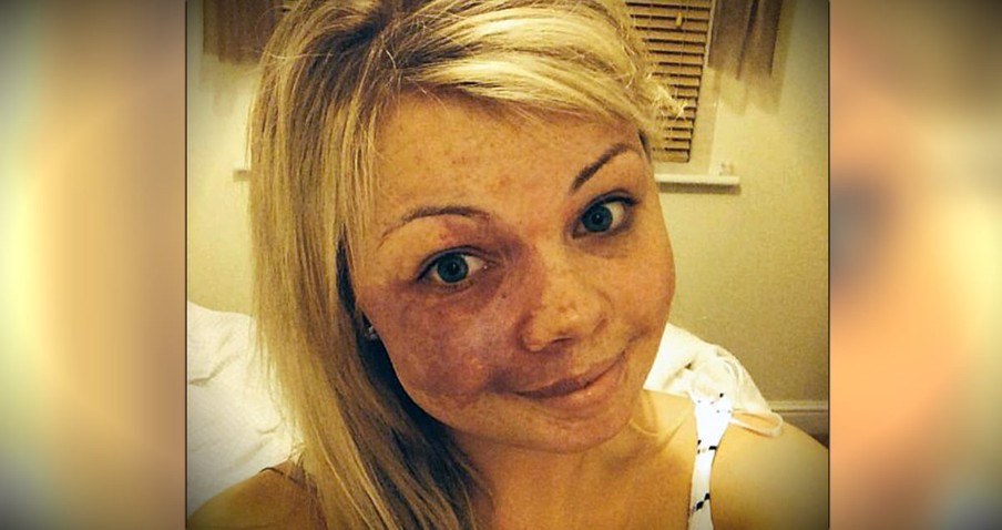 Woman With Birthmark Uses No Make-Up Selfie To Silence Bullies