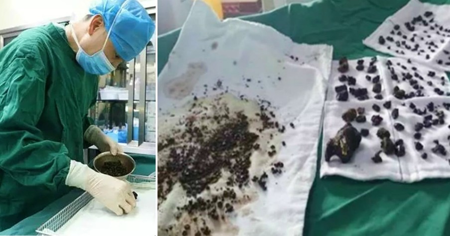 Woman Skipped Breakfast For Years Until Doctors Had To Remove 200 Gallstones