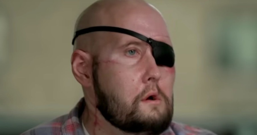 Lineman Lost Half His Face in Electrocution, but Eye and Face Transplant Changed Everything