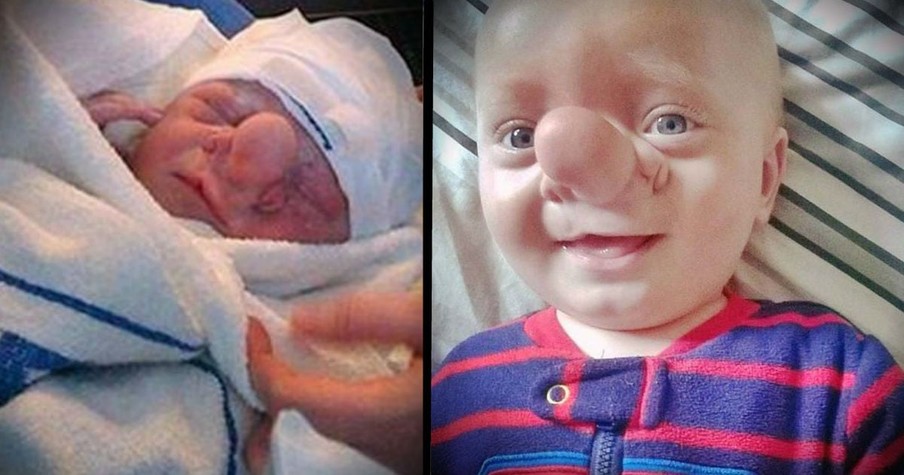 Bullies Call Boy With Brain Growing Into His Nose Ugly, But Mom Says He's Perfect