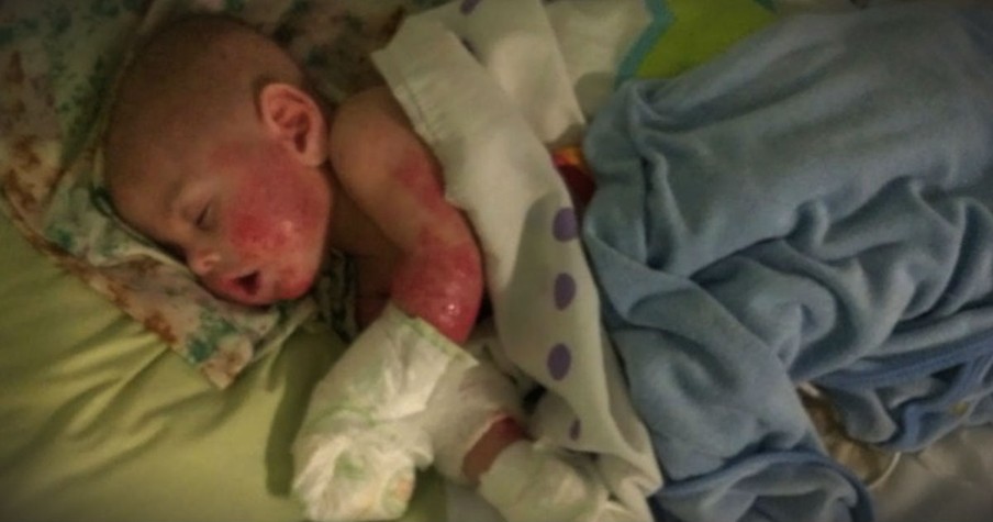 Mom Figures Out Why Her Baby's Skin Is 'Melting Off'