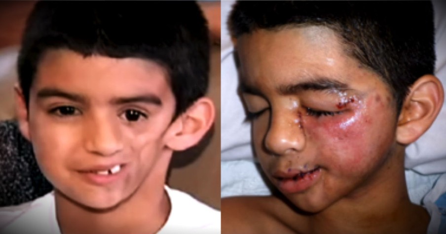 Young Boy’s Face Started Melting But He Knew God Had A Plan For Him