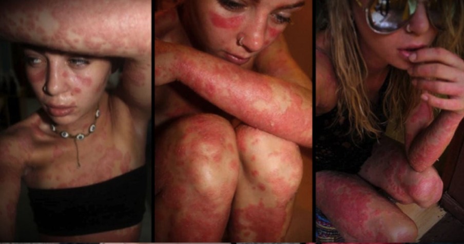 People Stare At Her Rash Covered Body, But She's Not Covering Up Anymore