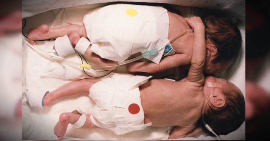 Babies Made History Over 20 Years Ago When An Infant Twin's Miracle Hug Saved The Other