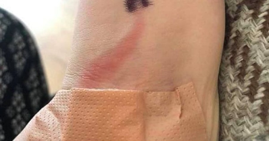 Mom Thinks She's 'Silly' for Son's ER Visit Until Doctors Explain the Red Line on His Arm