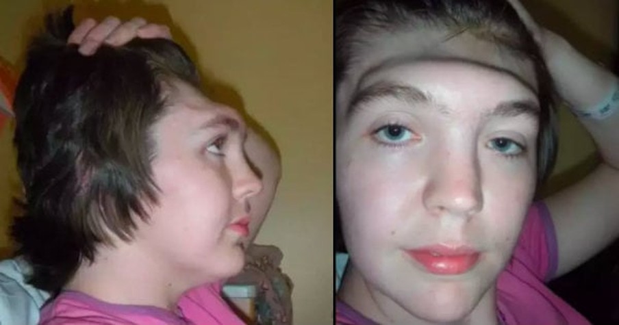 Woman Warns Others ‘Learn From My Mistake’ After She Lost Forehead From A Bad Habit