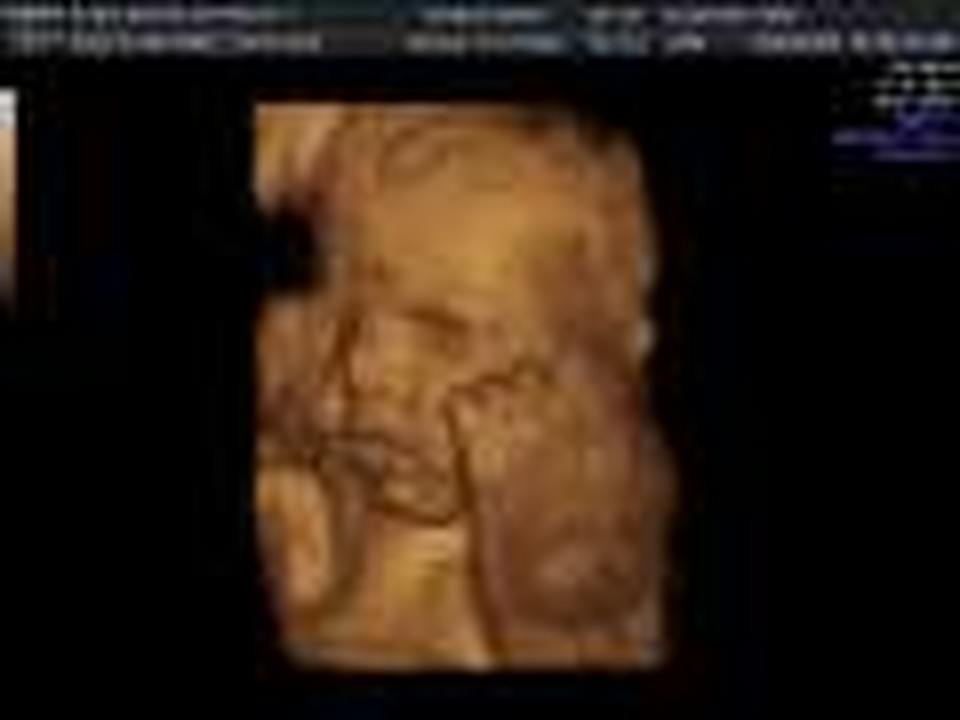 32 week ultrasound 2/408