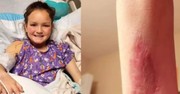 Mom Shares Terrifying Discovery That 'Pinch' on 9-Year-Old's Arm Was Brown Recluse Spider Bite