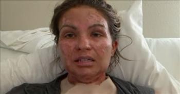 Woman Issues Warning After Suffering Severe Burns From Her Hand Sanitizer Catching Fire