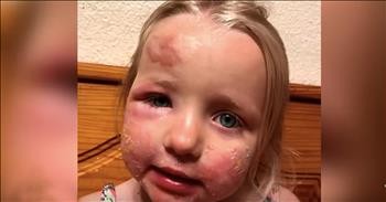 Mother Warns After Lime Juice Causes Severe Burns On Daughter