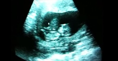Baby ‘Gymnast’ Plays Around During Ultrasound 