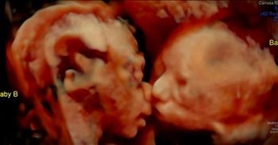 Mom-To-Be Sees Twins Kiss In Ultrasound 