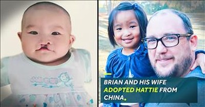 Man Adopts A Baby With Cleft Lip Just Like Him 