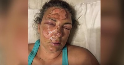 Woman Falls Face First Into Hot Grill But Survives