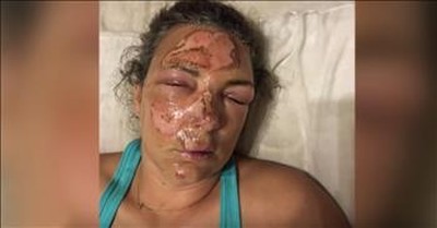 Woman Falls Face First Into Hot Grill But Survives 