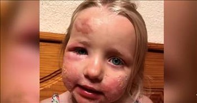 Mother Warns After Lime Juice Causes Severe Burns On Daughter 